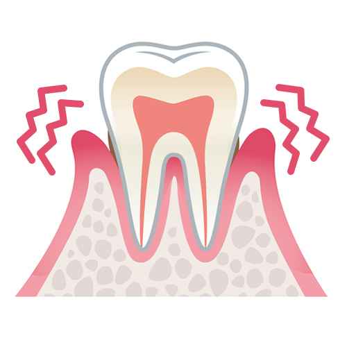 歯肉炎と歯周炎 画像