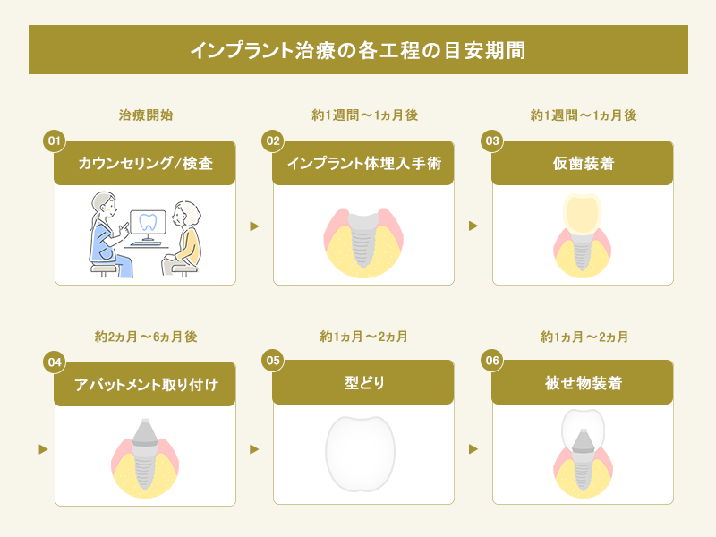 インプラントの治療工程と目安期間