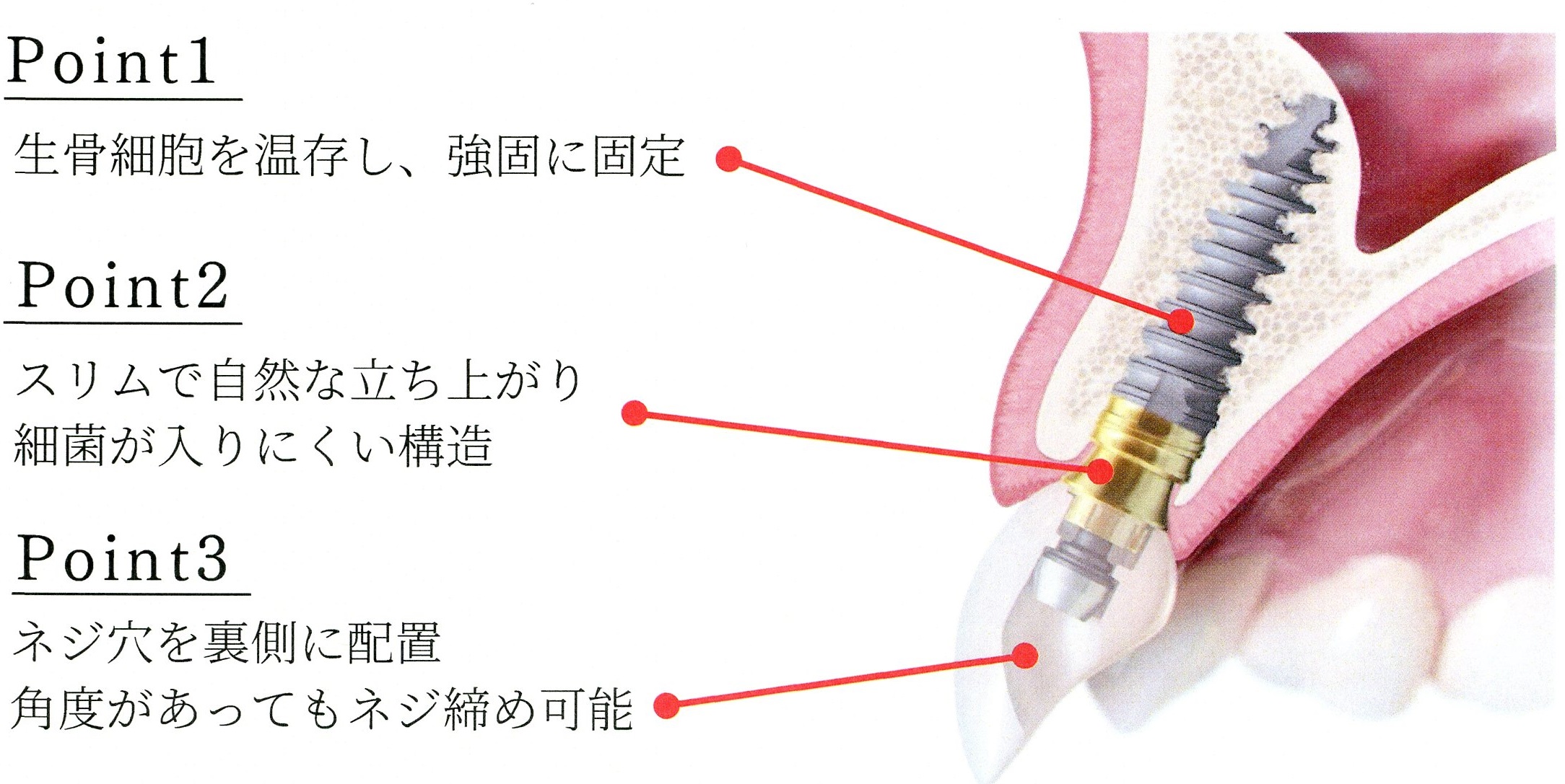 新しく導入したインプラント 画像