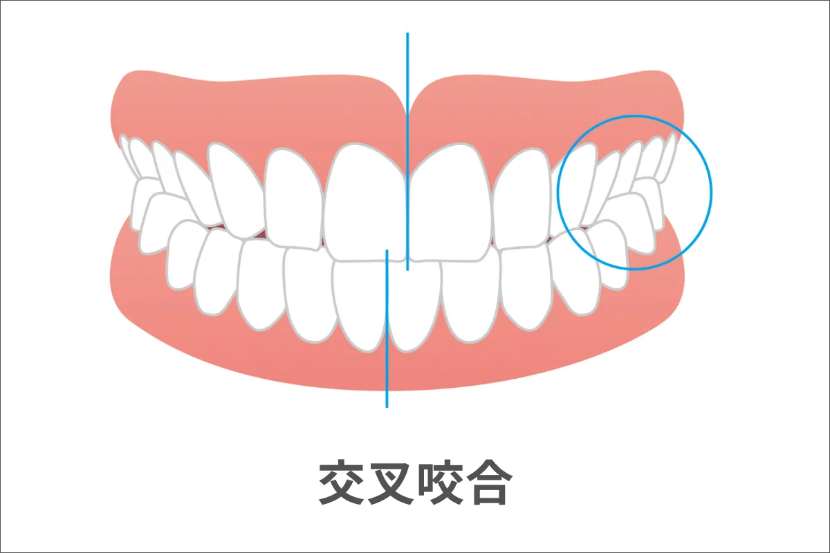 交叉咬合