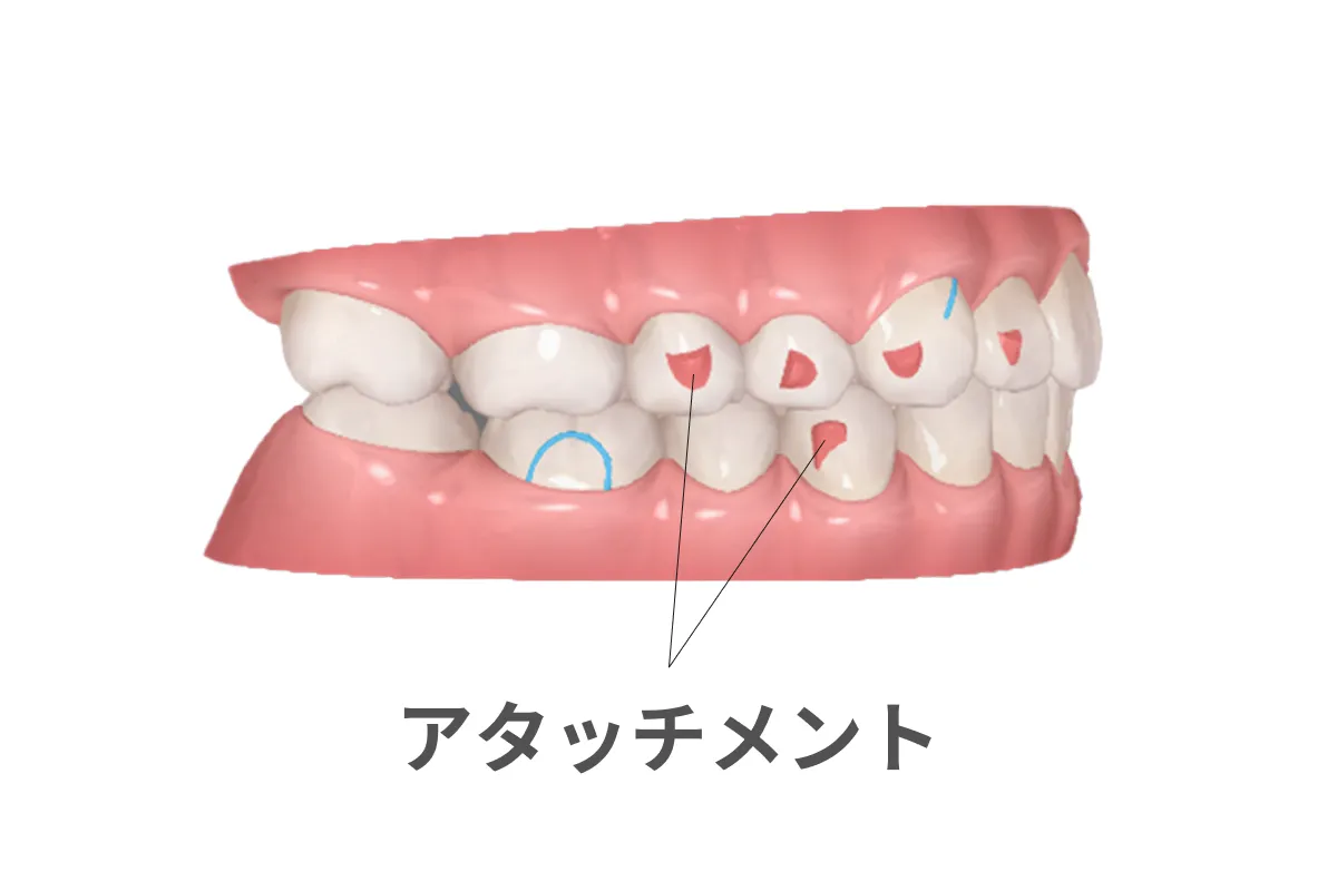 歯の移動をスムーズにするアタッチメント