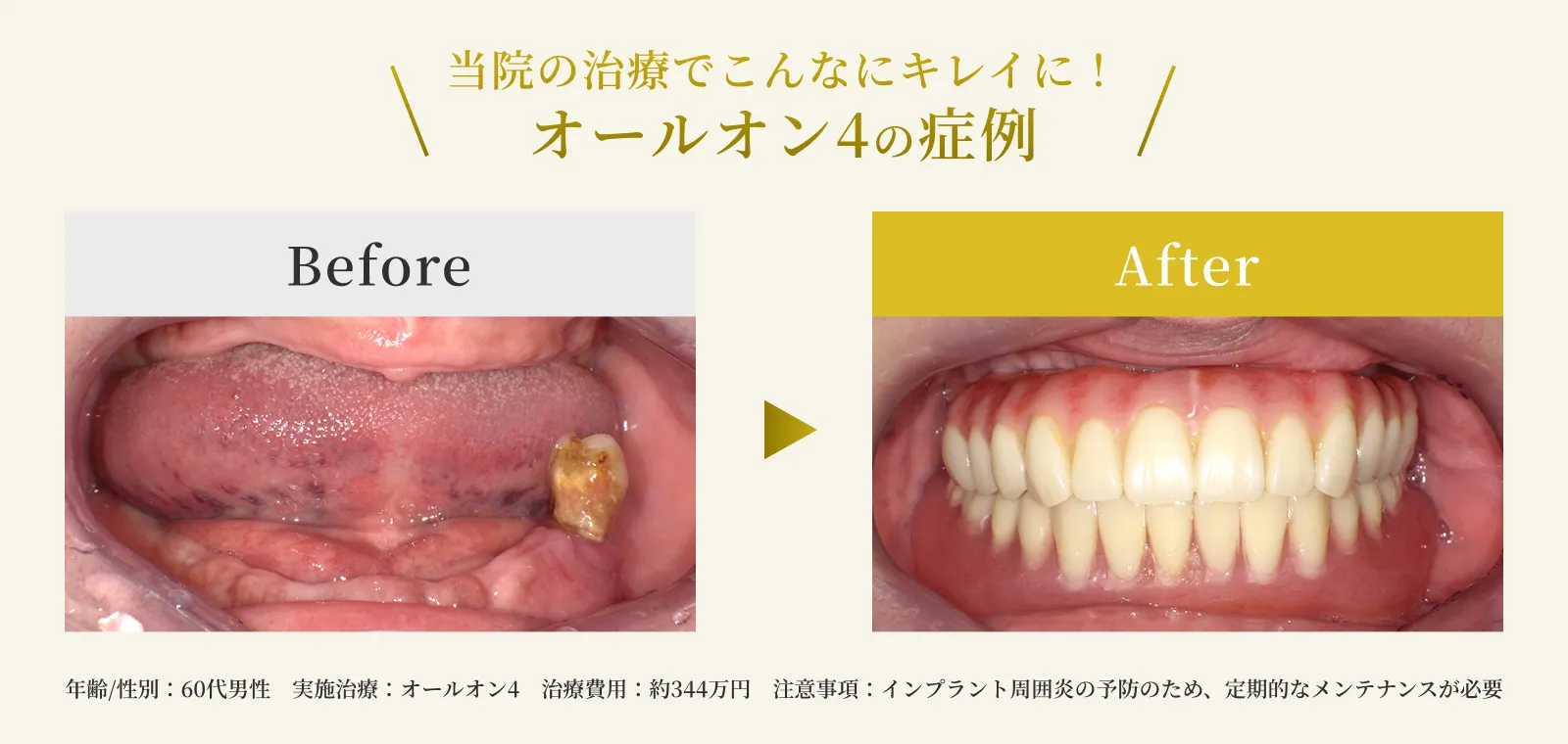 エス歯科のオールオン4の症例