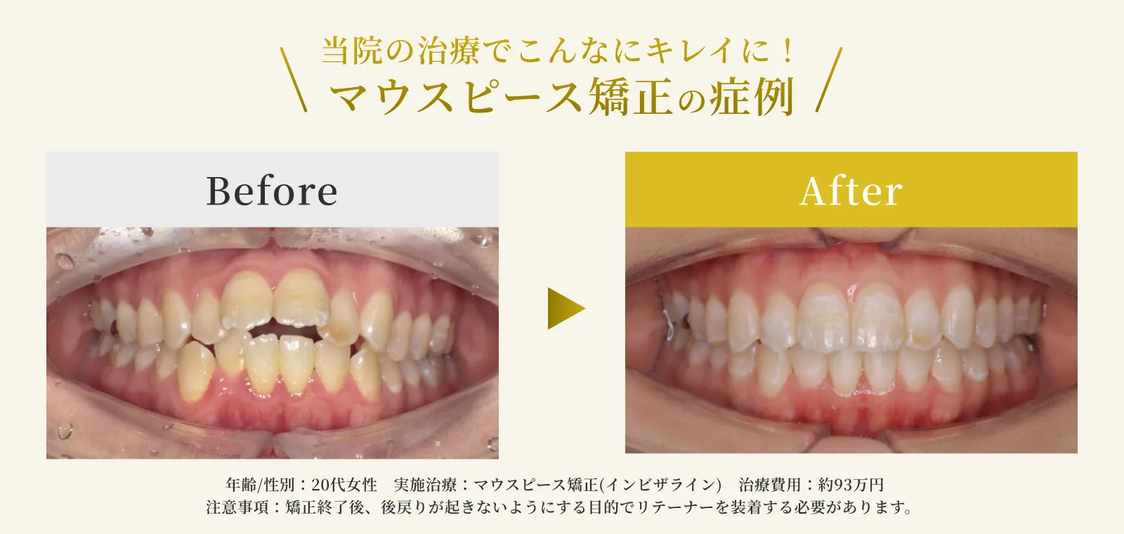 エス歯科クリニックのマウスピース矯正の症例