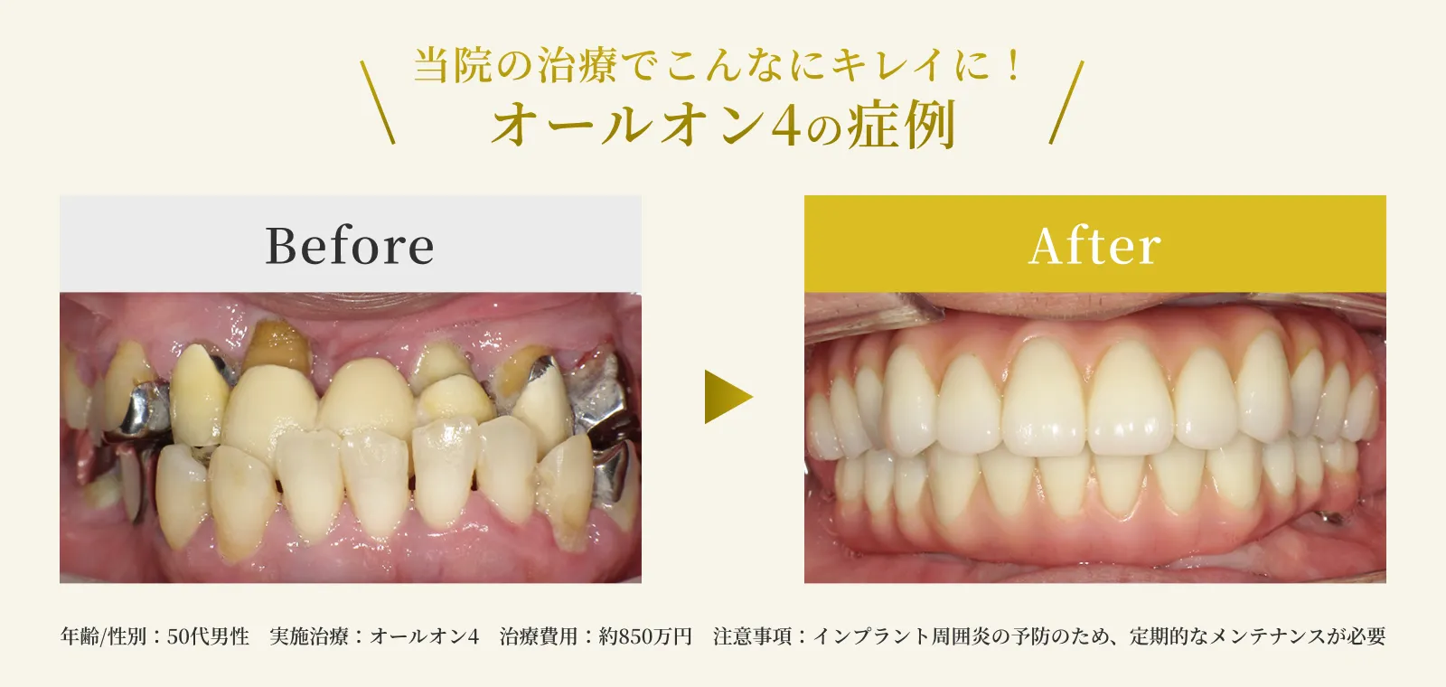 エス歯科のオールオン4の症例